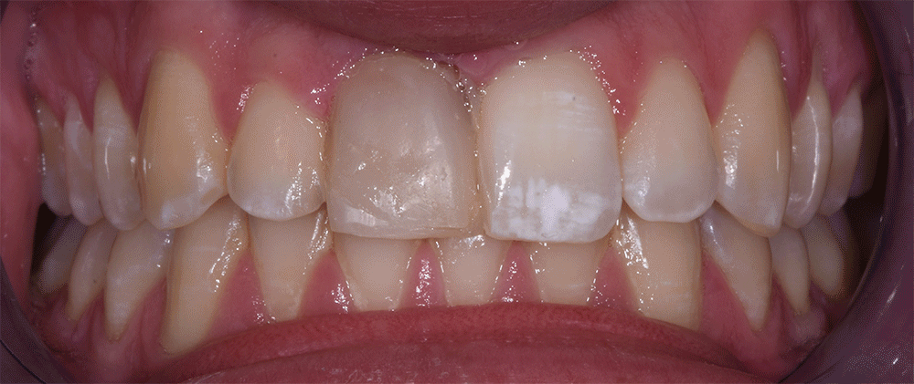 Teeth cleaning animated image